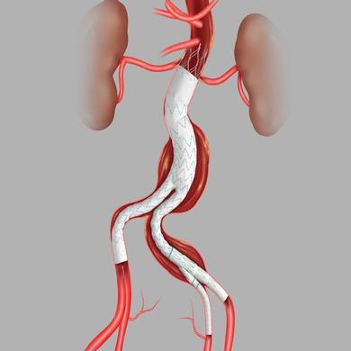 Zenith Alpha™ Abdominal Endovascular Graft Bifurcated Main Body Graft