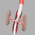 Zenith® t-Branch® Thoracoabdominal Endovascular Graft