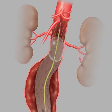 Coda® Balloon Catheter