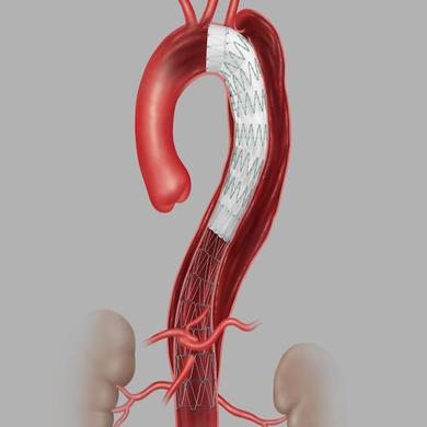 Zenith® TX2® Dissection Endovascular Graft with Pro-Form® 8 mm Tapered Components