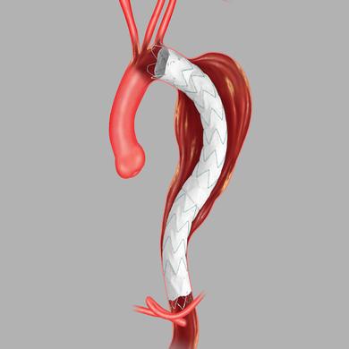 Zenith Alpha™ Thoracic Endovascular Graft Proximal Component