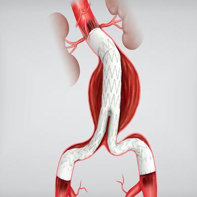 Zenith® Spiral-Z® AAA Iliac Leg Graft