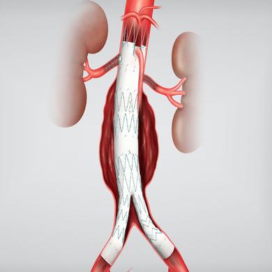 Zenith® Fenestrated AAA Endovascular Graft Proximal Body Grafts